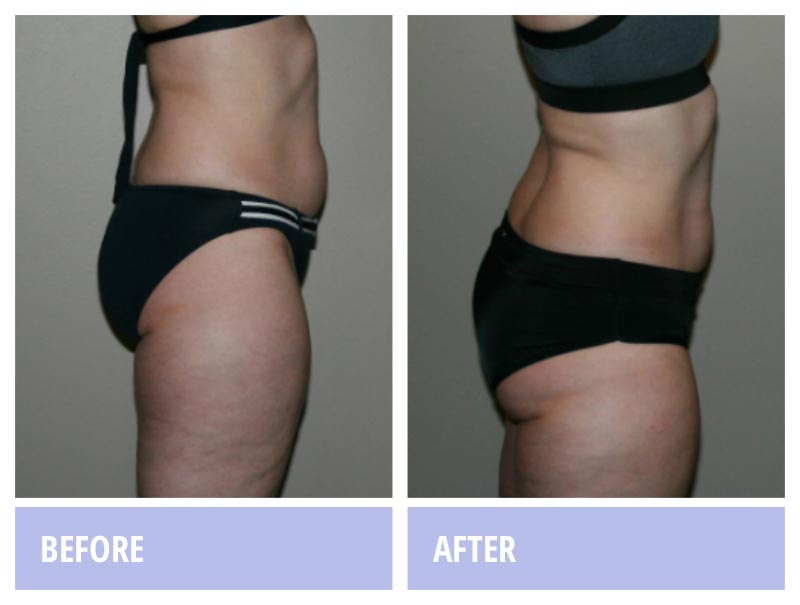 Before & After Images of Proven Weight Loss Using Zerona